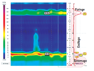 Evidencia de zonas de presi&oacute;n generadas por el EES y el EEI. LES: lower esophageal sphincter; UES: upper esophageal sphincter.
