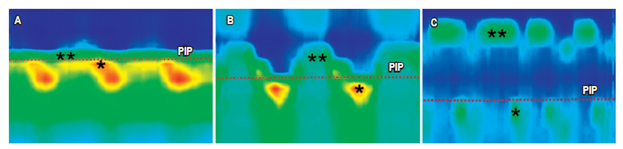 Morfolog&iacute;a de la UGE. Se clasifica en 3 tipos dependiendo del nivel de separaci&oacute;n que existe entre la ubicaci&oacute;n del EEI y el PIP (que indica el punto donde la presi&oacute;n, a trav&eacute;s de la UGE durante la inspiraci&oacute;n, se invierte de intraa&oacute;rtica negativa a intrag&aacute;strica positiva y representa la localizaci&oacute;n del DC). A. Tipo I, en el cual el EEI y el DC coinciden; B. Tipo II, cuando existe una peque&ntilde;a separaci&oacute;n espacial (<2 cm) entre el DC y el EEI; C. Tipo III, cuando existe una gran separaci&oacute;n espacial (>2 cm) entre el DC y el EEI. *DC; **EEI; PIP: l&iacute;nea punteada roja.