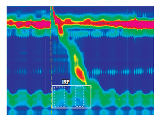 La IRP es la presi&oacute;n promedio m&aacute;s baja a trav&eacute;s de la UGE durante 4 segundos (cuadros punteados) continuos o discontinuos dentro de la ventana de 10 segundos (cuadro continuo) en una degluci&oacute;n.