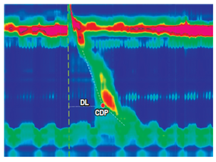 La DL representa el intervalo de tiempo (en segundos) entre la relajaci&oacute;n del EES y el CDP (punto rojo). CDP: punto a lo largo del contorno isob&aacute;rico de los 30 mm Hg donde la velocidad de propagaci&oacute;n se enlentece demarcando el es&oacute;fago tubular de la ampolla fr&eacute;nica.