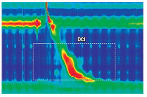 La DCI es una medida del vigor contr&aacute;ctil de la contracci&oacute;n esof&aacute;gica y representa la amplitud x duraci&oacute;n x largo (mm Hg/s/cm) de la contracci&oacute;n esof&aacute;gica en el contorno isob&aacute;rico de los 20 mm Hg (l&iacute;nea negra) a trav&eacute;s de las presiones de proximal a distal.