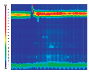 Acalasia tipo I (cl&aacute;sica). Se asocia con la presencia de IRP elevado (>15 mm Hg) y 100% de degluciones fallidas.