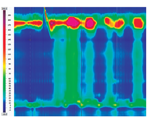 Acalasia tipo II. Se asocia con la presencia de IRP elevado (>15 mm Hg) y presencia de presurizaci&oacute;n panesof&aacute;gica (presurizaci&oacute;n de >30 mm Hg que se extiende desde el EES a la UGE).