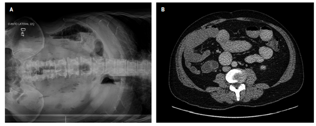 A. Radiografía de abdomen simple; y B. Corte sagital de tomografía de abdomen con contraste. Ambas imágenes muestran obstrucción intestinal y cambios estructurales no específicos en las asas ileales distales, sin signos de sufrimiento de asa.