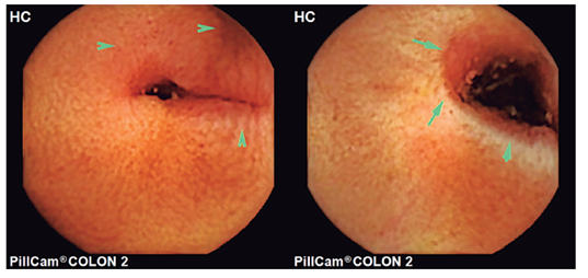 Videocápsula en la que se evidencia la presencia de estenosis y úlcera localizada en íleon medio sin sangrado activo.