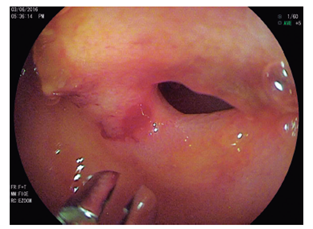 Enteroscopia por vía retrógrada en la que se observa una estenosis concéntrica de la luz a 190 cm en sentido ascendente de la válvula ileocecal con ulceración del borde libre sin evidencia de sangrado activo.