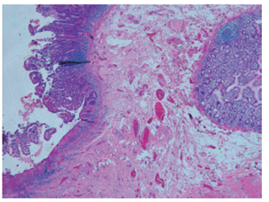 Hematoxilina y eosina 4X. Muestra de la pared del intestino con alteración de la arquitectura. A la izquierda de la microfotografía hay ulceración, con infiltrado linfoplasmocitario y formación de acúmulos linfoides, con área de fibrosis submucosa. A la derecha hay glándulas irregulares, con metaplasia pseudopilórica.