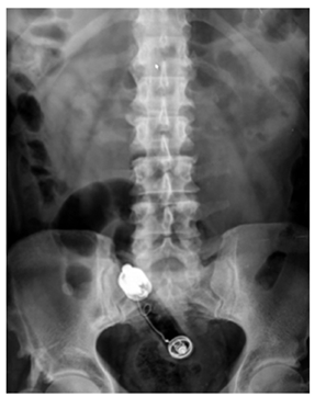 Rx de abdomen anteroposterior.