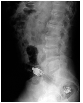 Rx de abdomen lateral.