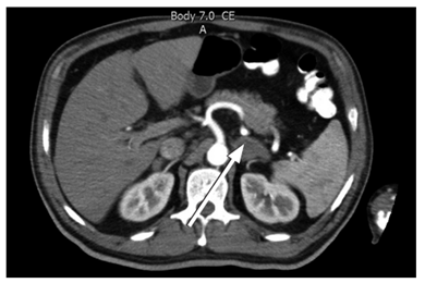 TAC de abdomen en la que se aprecia un aumento difuso de ambas glándulas suprarrenales, predominantemente la izquierda (flecha blanca).