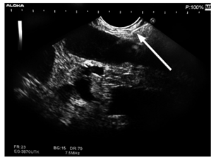 Endosonografía con visualización de la glándula suprarrenal izquierda aumentada de tamaño, de aspecto heterogéneo, hipoecogénica, con aspecto de masa. Biopsia por punción de glándula suprarrenal izquierda guiada por endosonografía (flecha blanca).
