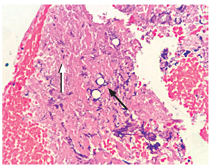 Visualización histológica con coloración de hematoxilina-eosina, tejido necrótico (flecha blanca) de glándula suprarrenal izquierda con presencia de levaduras multigemantes (flecha negra).