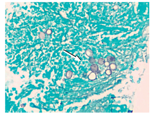 Histología, coloración de Gomori-Grocott. Evidencia de levaduras multigemantes compatibles con paracoccidioidomicosis (flecha blanca).