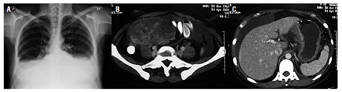 A. Radiografía de tórax, derrame plural. B. Tomografía con masa anexial derecha. C. Tomografía con líquido peritoneal y engrosamiento de paredes del estómago.