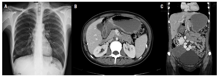 2. A. Radiografía de tórax normal. B. Tomografía con engrosamiento de las paredes del estómago- corporal. C. Masa anexial derecha.