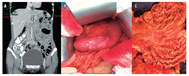 A. Tomografía de abdomen normal. B. Engrosamiento de las paredes de la región corporal gástrica. C. Pieza quirúrgica con lesión gástrica corporal.