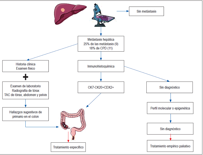 Esquema diagn&oacute;stico de met&aacute;stasis hep&aacute;tica con perfil de adenocarcinoma de colon. CDX2: caudal-related homeobox transcription factor2; CK: citoqueratina.