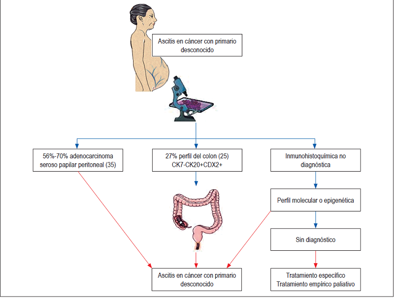 Esquema diagn&oacute;stico de ascitis en c&aacute;ncer con primario desconocido con diferenciaci&oacute;n de adenocarcinoma seroso papilar peritoneal o adenocarcinoma con perfil de colon.