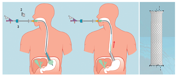 Sistema de colocación del dispositivo SX-Ella Danis stent (Ella-CS, Hradec Kralove, República Checa).