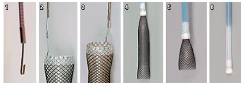 Sistema de retiro del dispositivo SX-Ella Danis stent (Ella-CS, Hradec Kralove, República Checa).