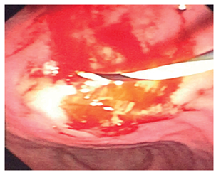 Paso de la guía hidrofilica al pseudoquiste pancreático antes del corte de la pared gástrica con el citostomo.