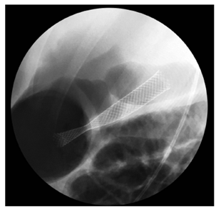 Imagen fluoroscópica. Stent biliar metálico completamente cubierto que drena el pseudoquiste pancreático al estómago.
