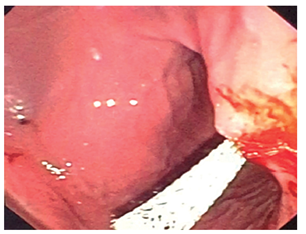 Visión endoscópica de la copa proximal de la prótesis con adecuada reexpansión y funcional.