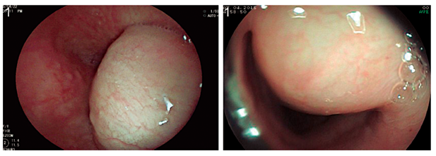 Visi&oacute;n endosc&oacute;pica de la lesi&oacute;n subepitelial esof&aacute;gica.