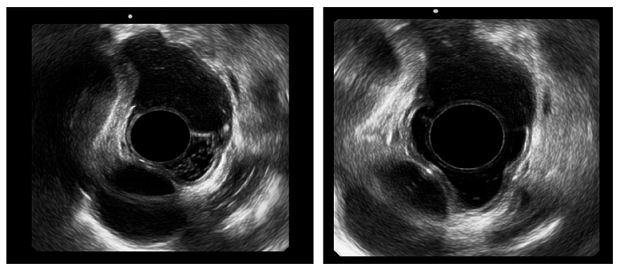 Endosonograf&iacute;a radial. Se observa una lesi&oacute;n subepitelial de la tercera capa esof&aacute;gica, hipoecoica.