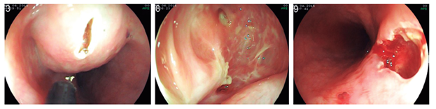 Incisi&oacute;n de la lesi&oacute;n. Se observa el quiste de duplicaci&oacute;n por dentro y al final el orificio que queda a la luz del es&oacute;fago.