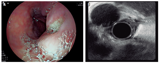 Control al cuarto d&iacute;a. A. Visi&oacute;n endosc&oacute;pica que muestra el orificio externo a la luz del es&oacute;fago. B. EUS. Aorta a las 11 del visor y el quiste ya reducido posdrenaje.
