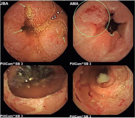 A. Enteritis ulcerada con estenosis por consumo de glucosamina. B. Ile&iacute;tis ulcerada en paciente con enfermedad de Crohn. C. &Uacute;lcera inflamatoria hemicircunferencial en &iacute;leon en paciente con enfermedad de Crohn. D. &Uacute;lceras inflamatorias en yeyuno con sangrado activo.