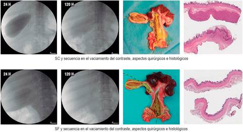 Aspectos a la CPRE, cirug&iacute;a e histolog&iacute;a del SC y el SF.