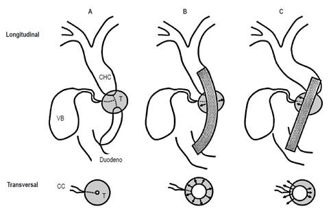 Vista longitudinal y transversal de los efectos de la FA del stent met&aacute;lico liberado en pacientes con compromiso tumoral del conducto c&iacute;stico (11). A. Antes de la colocaci&oacute;n del stent. B. Despu&eacute;s de colocar un stent con baja FA. C. Despu&eacute;s de colocar un stent con alta FA. CC: conducto c&iacute;stico; CHC: conducto hep&aacute;tico com&uacute;n; T: tumor; VB: ves&iacute;cula biliar. Modificado de: Nakai Y et al. J Gastroenterol Hepatol. 2014;29(7):1557-62.