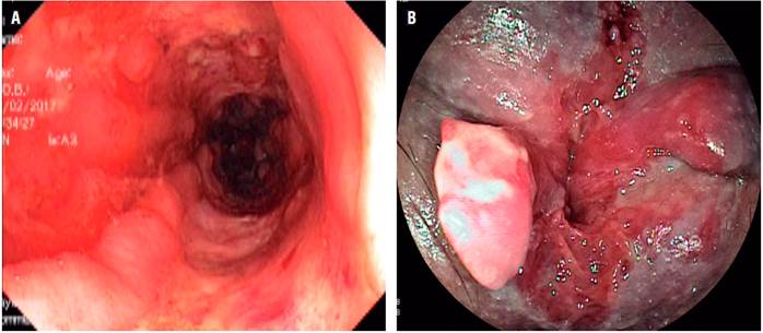 A. Severos cambios inflamatorios y &uacute;lceras profundas, longitudinales en el colon (paciente con diagn&oacute;stico de EC). B. Compromiso perianal por EC.