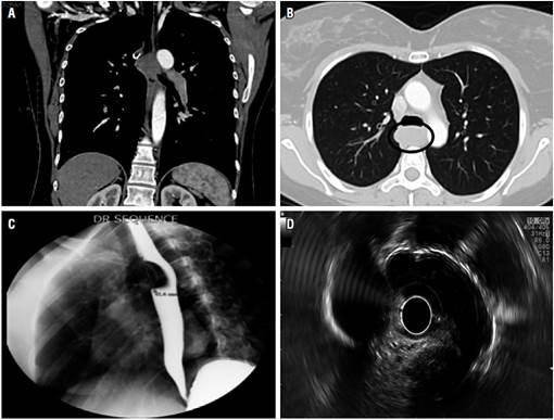 A y B. Tomograf&iacute;a de t&oacute;rax con contraste: evidencia una masa esof&aacute;gica heterog&eacute;nea con medias de 4,1 cent&iacute;metros. C. El esofagograma demuestra un defecto de llenado en el es&oacute;fago con superficie mucosa lisa intacta. D. La ultrasonograf&iacute;a endosc&oacute;pica del es&oacute;fago revela una masa hipoecoica bien circunscrita originada en la capa muscular propia.