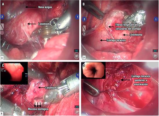 A. Imagen del leiomioma cubierto por pleura mediast&iacute;nica del es&oacute;fago antes de la disecci&oacute;n. B y C. La visualizaci&oacute;n del leiomioma despu&eacute;s de la disecci&oacute;n con la inspecci&oacute;n esofagosc&oacute;pica durante la cirug&iacute;a, asegurando la completa escisi&oacute;n del tumor y D. la integridad de la mucosa despu&eacute;s de la enucleaci&oacute;n con gu&iacute;a endosc&oacute;pica.