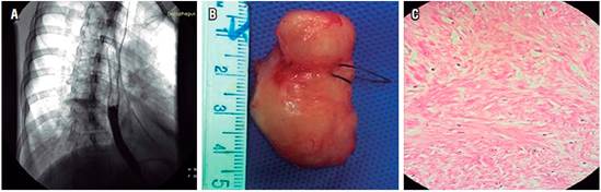 A. Esofagograma postoperatorio: evidencia de integridad del es&oacute;fago tor&aacute;cico sin evidencia de estenosis y sin evidencia de f&iacute;stulas. B. Pieza quir&uacute;rgica del leiomioma despu&eacute;s de la enucleaci&oacute;n que revela una masa de 4 cm con una pseudoc&aacute;psula intacta. C. Vista microsc&oacute;pica del tumor (inserci&oacute;n H/E x 200).