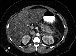 TAC de abdomen con doble contraste. Se evidencia colecci&oacute;n definida peripancre&aacute;tica, principalmente hacia la cola del p&aacute;ncreas compatible con Baltazar D.