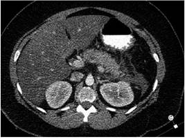 TAC de abdomen con doble contraste. Se evidencia colecci&oacute;n definida peripancre&aacute;tica, principalmente hacia la cola del p&aacute;ncreas compatible con Baltazar D.