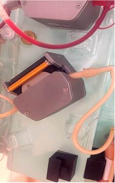 Se muestra proceso y resultado de plasmaf&eacute;resis inicial de paciente, con pancreatitis severa por hipertrigliceridemia.