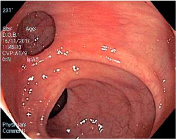 Divert&iacute;culo rectal.