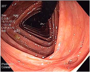 Retroflexi&oacute;n del colon derecho con divert&iacute;culo.