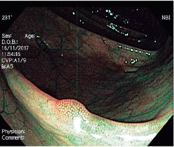 P&oacute;lipo adenomatoso de colon.