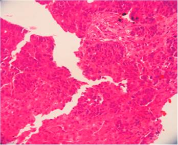 Microfotograf&iacute;a de biopsia hep&aacute;tica que muestra infiltraci&oacute;n metast&aacute;sica difusa por nidos celulares malignos. H/E-20 X.