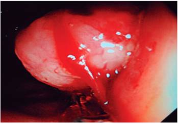 Imagen colonosc&oacute;pica a nivel de la v&aacute;lvula ileocecal. Obs&eacute;rvese la imagen tumoral exof&iacute;tica.