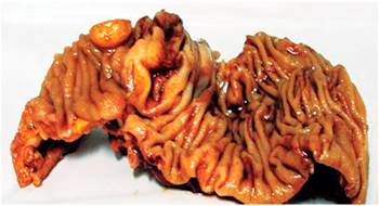 Macrofotograf&iacute;a a nivel del &iacute;leon terminal. Obs&eacute;rvese la lesi&oacute;n tumoral redondeada de color amarillo oscuro a 1 cm y medio de la v&aacute;lvula ileocecal.