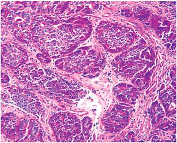 Microfotograf&iacute;a de la lesi&oacute;n intestinal que muestra nidos bien delimitados de c&eacute;lulas tumorales malignas con caracter&iacute;sticas histol&oacute;gicas neuroendocrinas. H/E-20 X. 