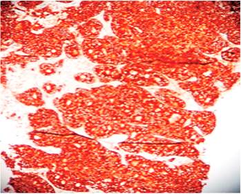 Lesi&oacute;n intestinal: reacci&oacute;n intensamente positiva para sinaptofisina. IHQ-20 X.