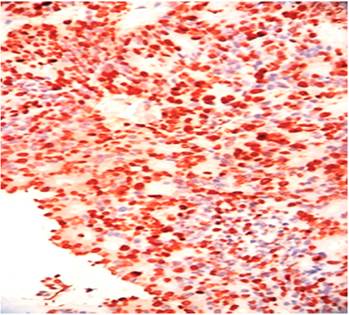 Lesi&oacute;n intestinal: positividad para Ki 67. IHQ-40 X.